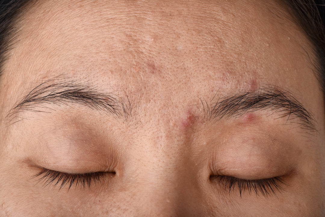 Why is Sugar Detrimental to Skin Health?