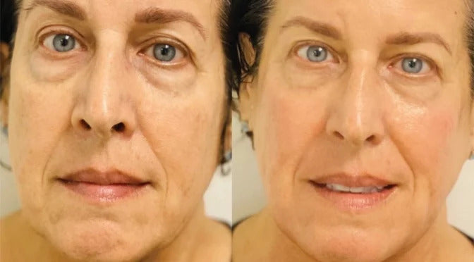 a before and after pic of a woman who underwent treatments at lotus evolution